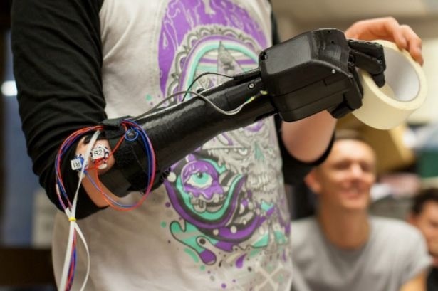 Lihatlah Senyuman Lelaki Yang Kudung Sejak Lahir Mendapat Tangan Robotik