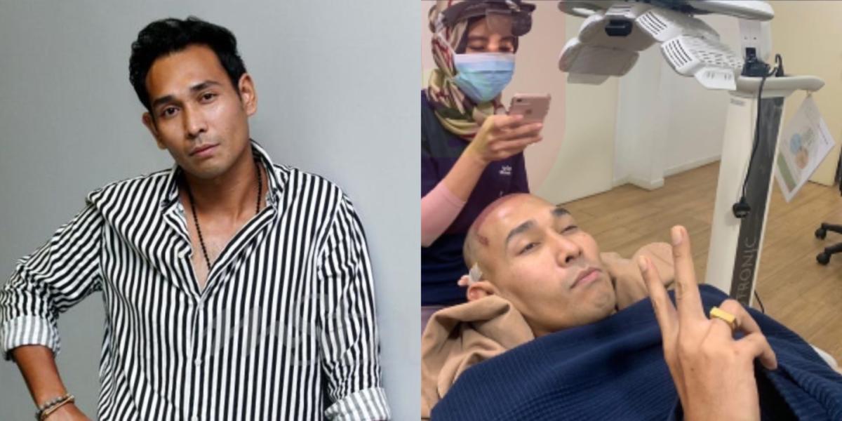 Berharga RM6 Sehelai, Lelaki Ini Buat Rawatan Tanam 4,083 Helai Rambut