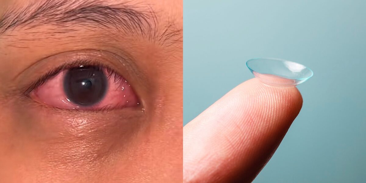 Gara-Gara Beli ‘Contact Lens’ Dari TikTok, Wanita Alami Sakit Mata Yang Teruk
